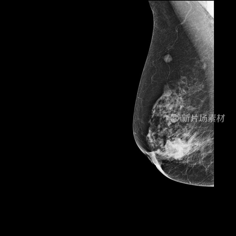 数字乳房x光检查显示乳腺癌