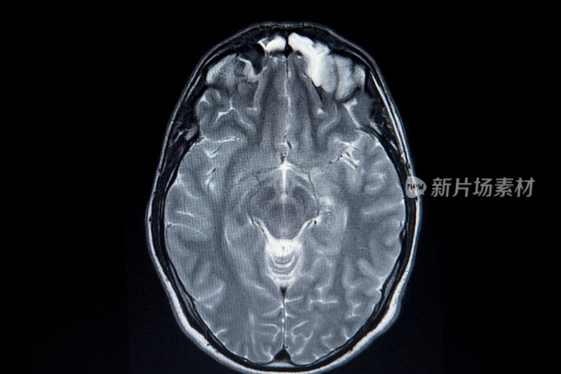医院的灰白色核磁共振脑部扫描。