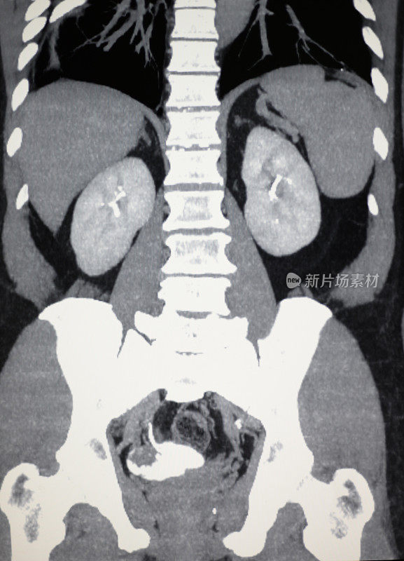 膀胱癌的CT影像