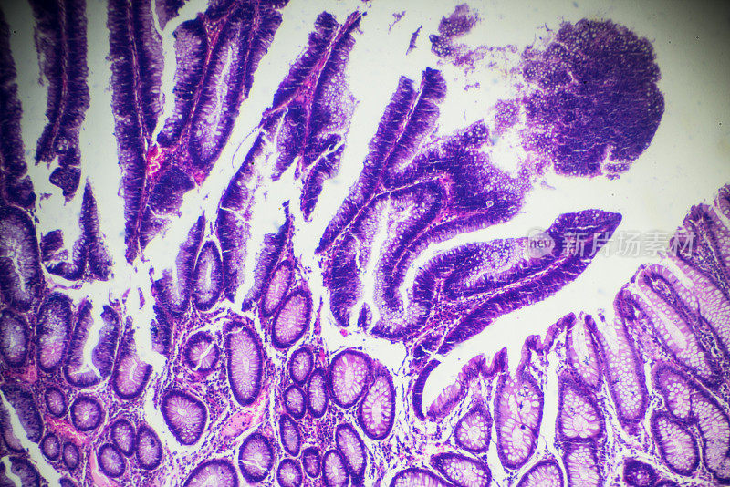 肠腺瘤病人体病理标本的显微镜观察