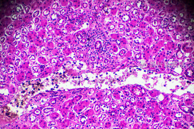 显微镜下急性肾盂肾炎活检标本