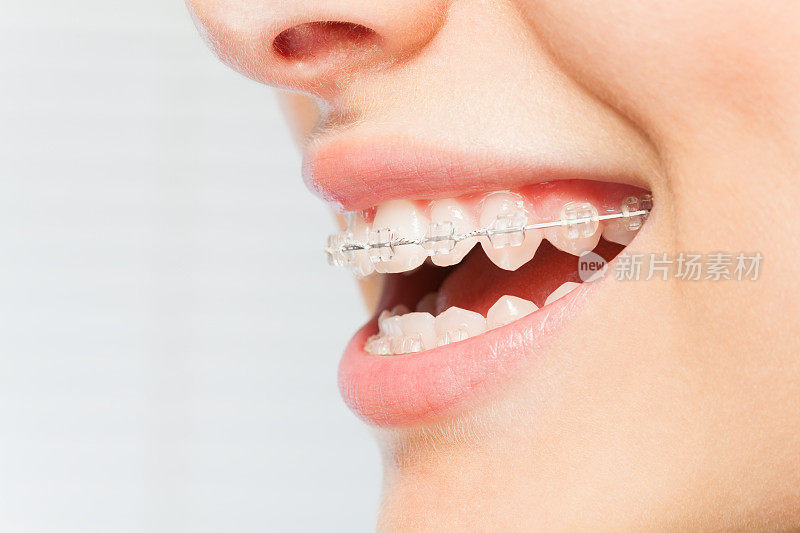 女人的微笑和牙齿上的牙齿矫正器