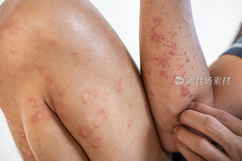 亚洲腿和手臂的特应性皮炎皮肤问题