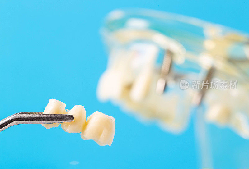 牙桥在镊子对背景医学模型的牙颌，特写。正畸学和牙科中的牙修复学。现代技术。文本复制空间