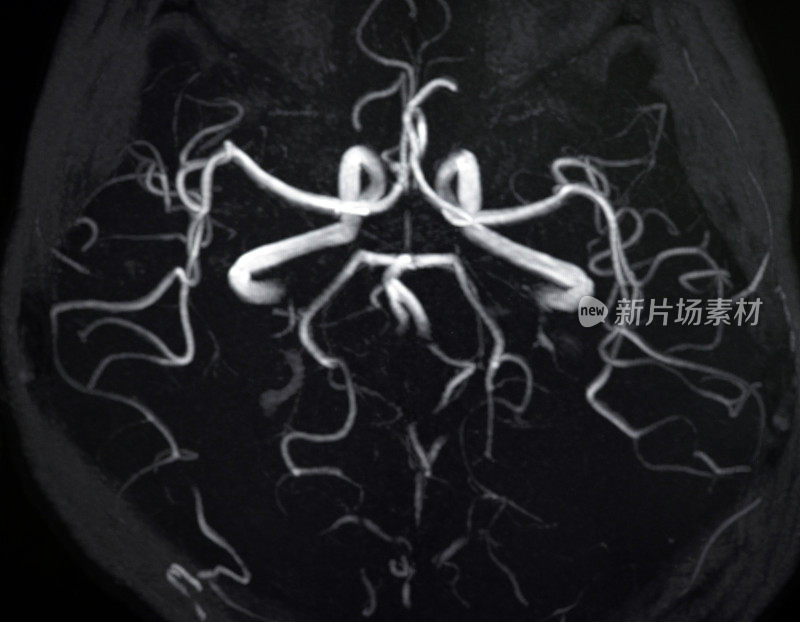 颅内动脉MRA图像