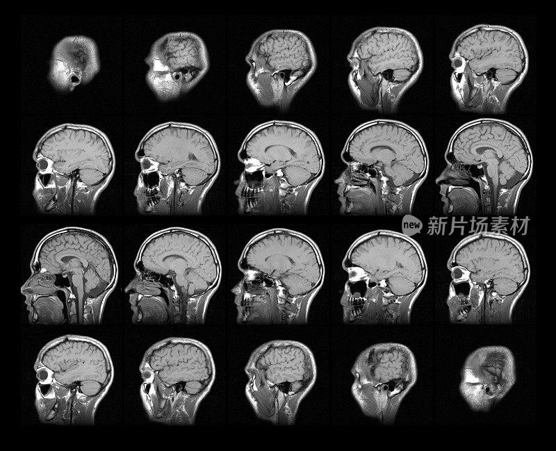 磁共振成像(MRI)