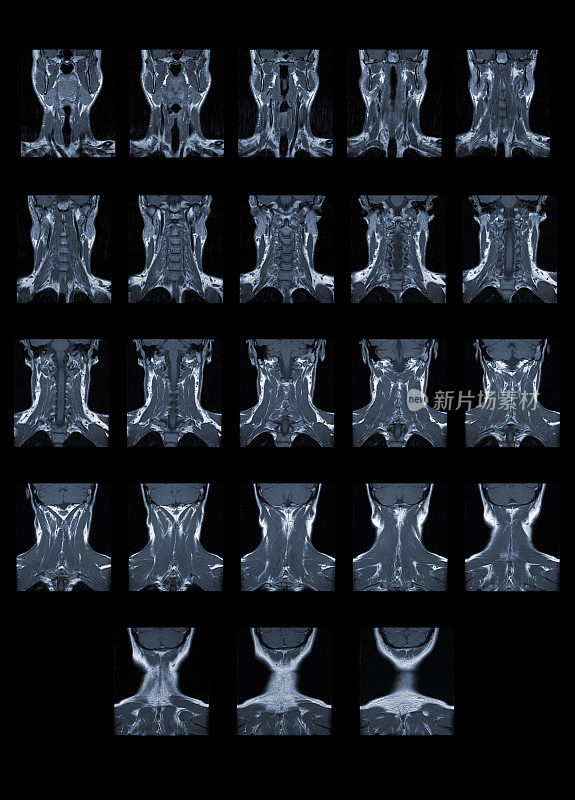 MRI扫描人脊柱