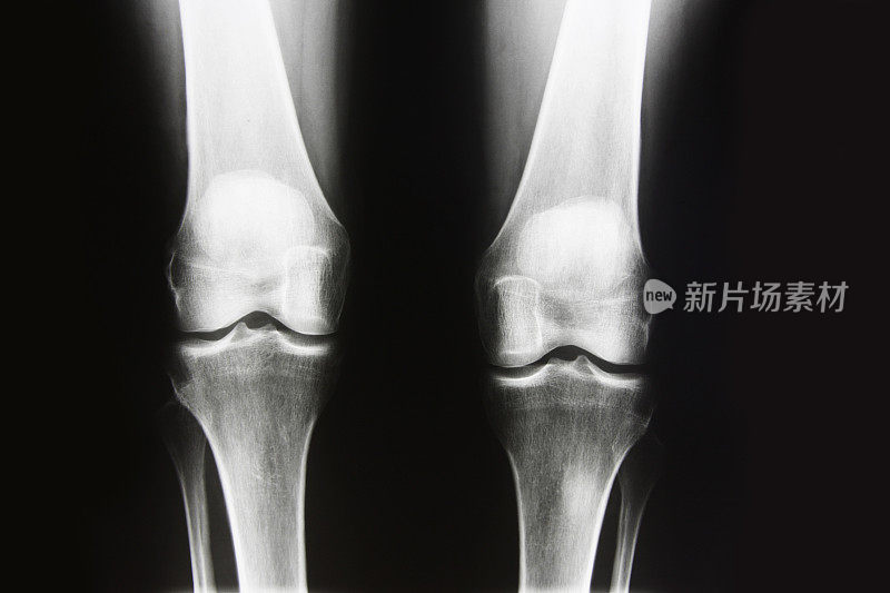 膝盖的x光照片，正面