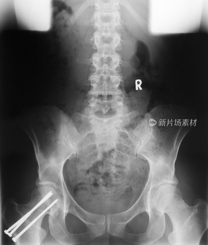 人体臀部和脊柱的医学x光片在医生的灯箱上