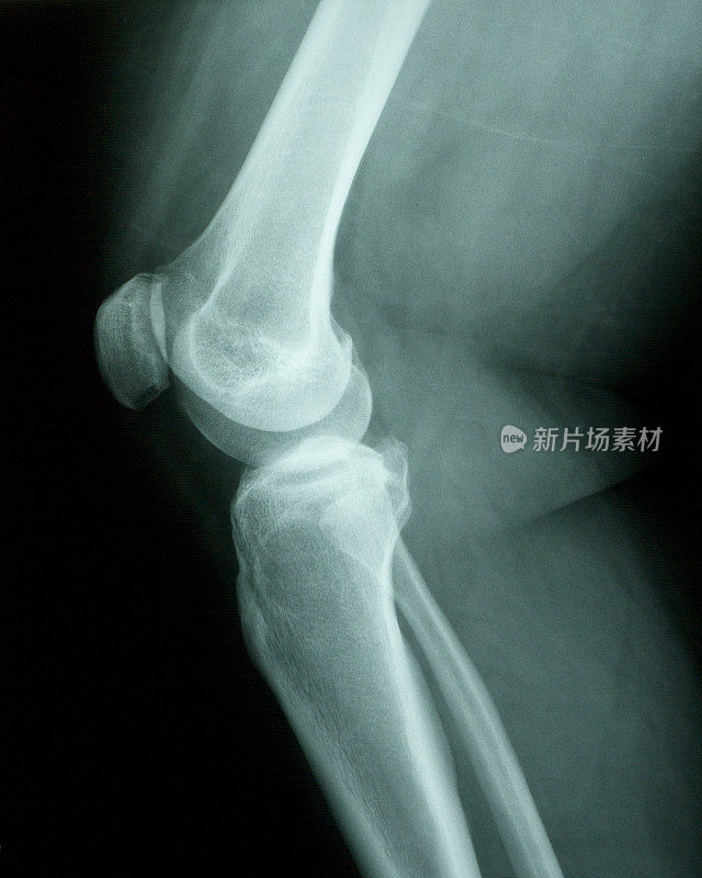 人工膝关节x射线