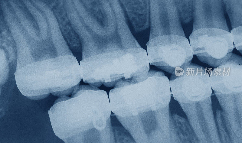 带牙套的牙齿x光片