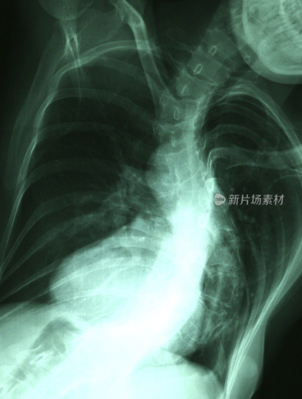 人体脊柱x光图像