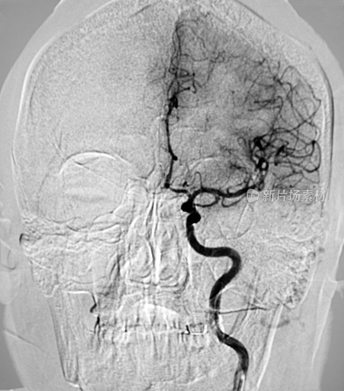 颈内动脉DSA图像