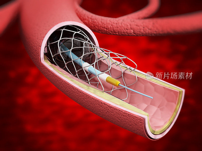 血管内的血管支架