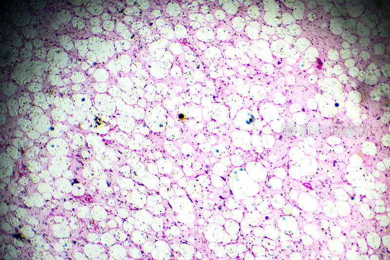 脂肪肉瘤镜检活检