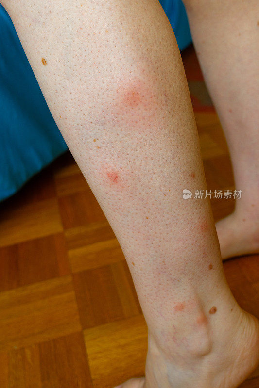 腿部有许多红斑和蚊虫叮咬(昆虫叮咬)留下的疤痕。蚊子过敏