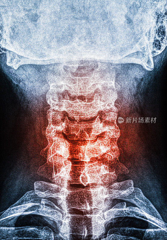 对受伤颈部的x光扫描