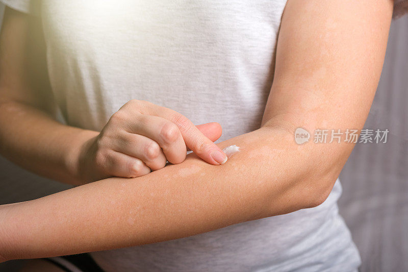 一名年轻女子在手上涂抹止痒皮炎膏。过敏性皮炎。皮肤病白癜风。神经性皮炎、湿疹或过敏性皮疹。医疗保健和医疗。
