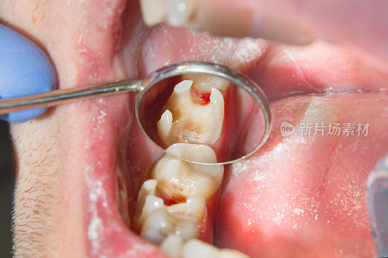 一颗在牙科诊所接受治疗的蛀牙的特写