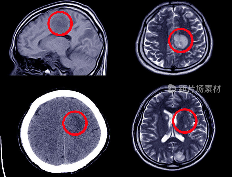 脑部CT扫描显示颅内出血-轴向切面