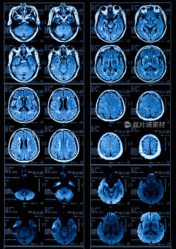 MRI扫描人类头部断层扫描