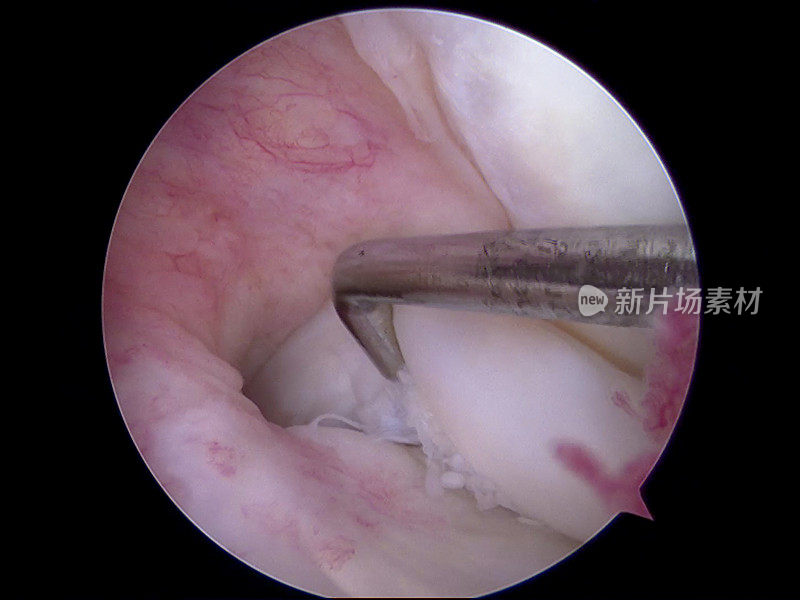 内侧半月板桶柄撕裂移位的关节镜观察