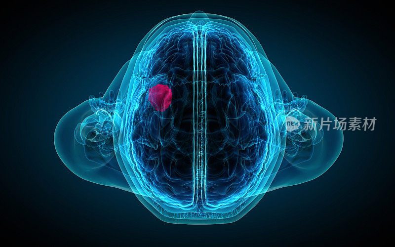 脑x光片显示肿瘤