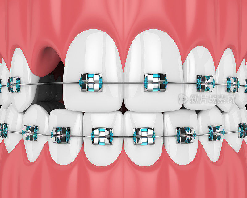 牙齿的牙套和腔的3d渲染