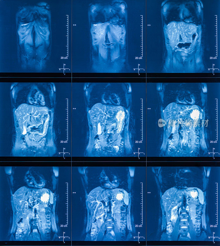MRI扫描人体腹部断层扫描