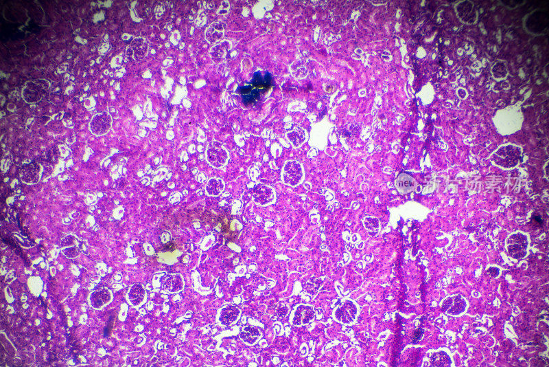 显微镜下急性肾盂肾炎活检标本