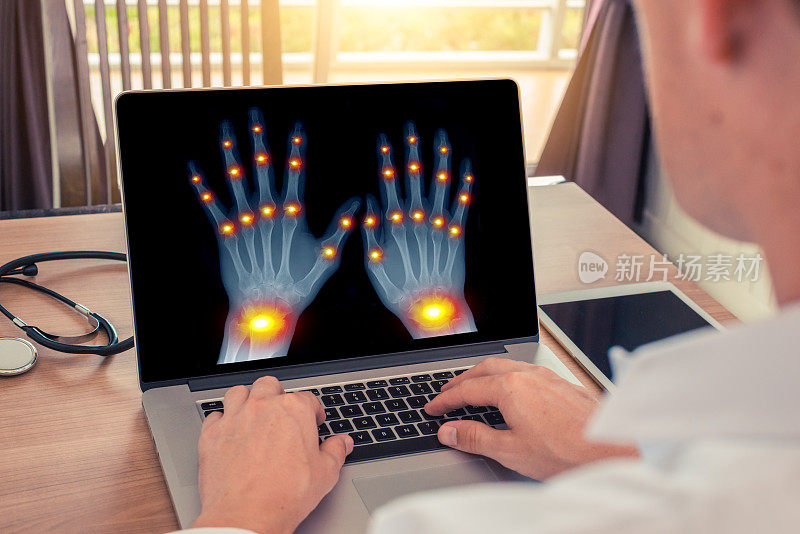 医生在看手部x光片，手指和手腕关节疼痛。放射学和骨关节炎概念