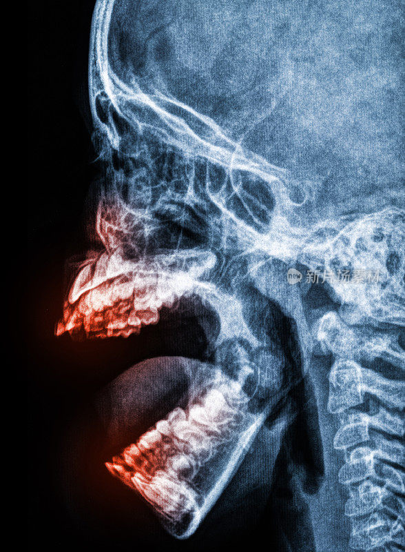 x射线扫描人类头骨和颌骨疼痛