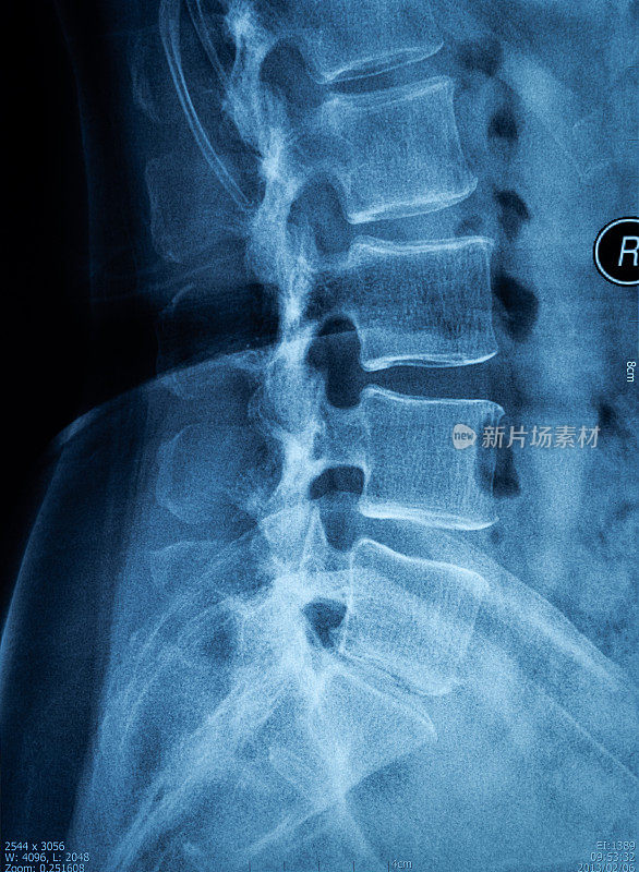 脊柱x射线胶片