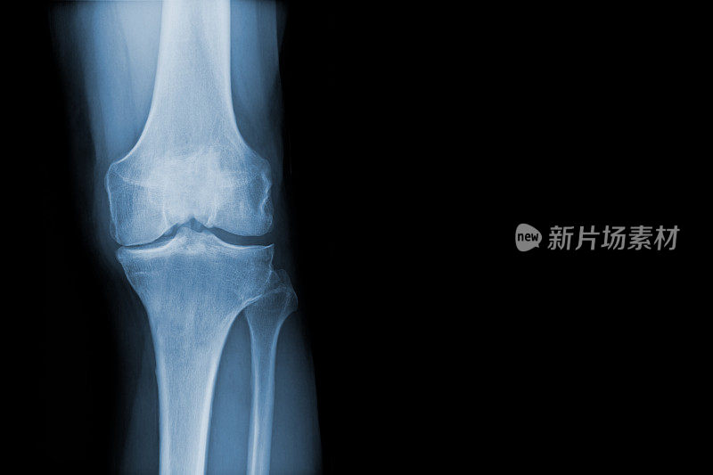 全膝关节置换术前伴有骨性关节炎的膝关节x线照片。前面的观点。
