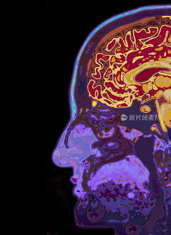 头部MRI扫描显示大脑