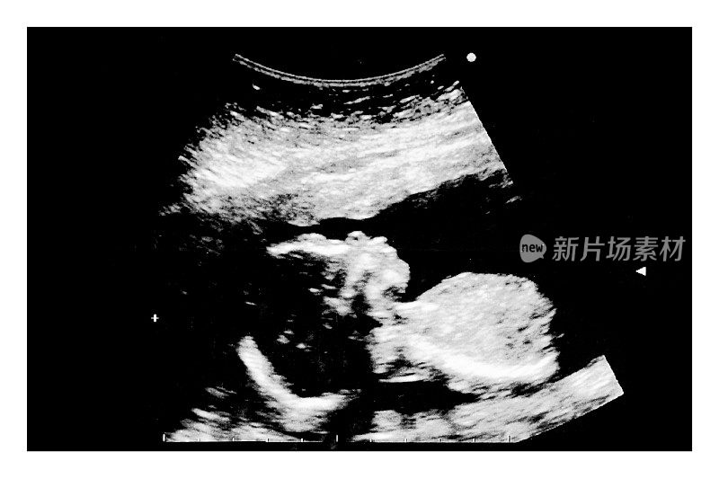 母亲子宫内婴儿的超声波图。