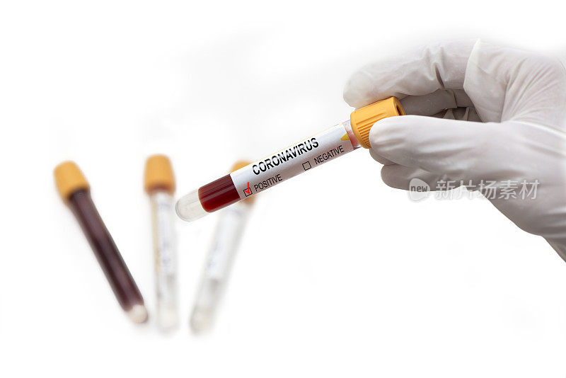 手握冠状病毒阳性血液样本