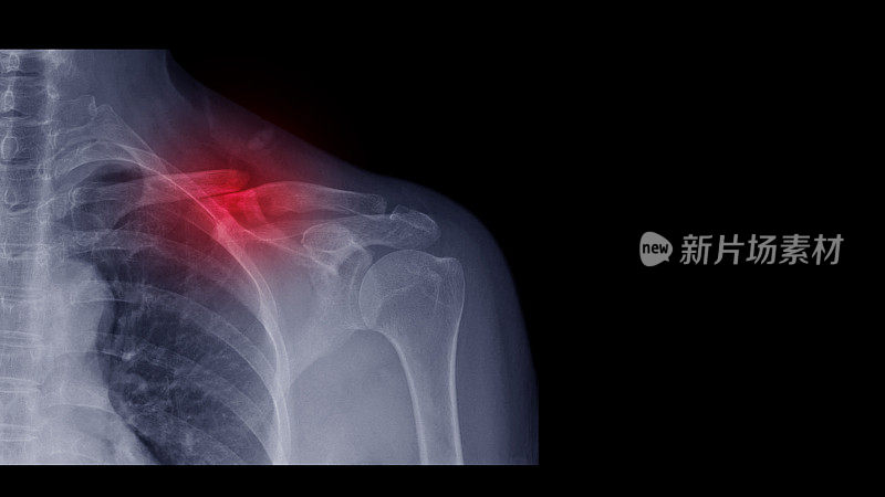 肩部x线片显示运动损伤导致锁骨骨折。突出骨折部位和疼痛部位。医学技术和影像概念。