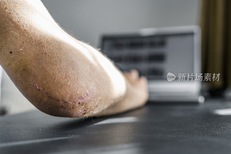 一个用笔记本电脑工作的人手肘上的大伤疤