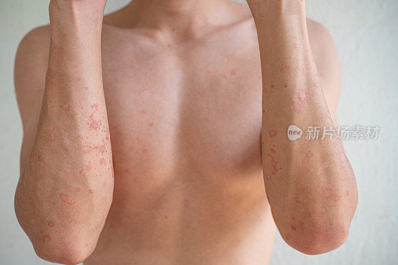 特写亚洲男性手臂皮肤特应性皮炎干燥皮肤