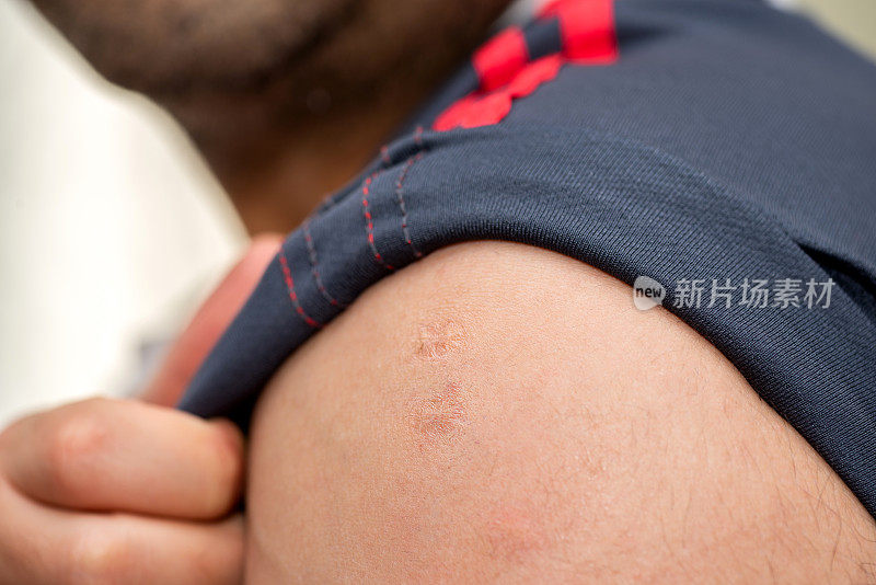 男子手臂上出现猴痘和天花疫苗留下的疤痕
