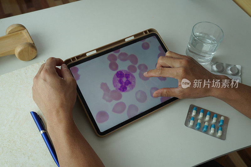 亚洲男性通过数字平板看一看血液中的白血病细胞，就知道自己白血病的阶段了。