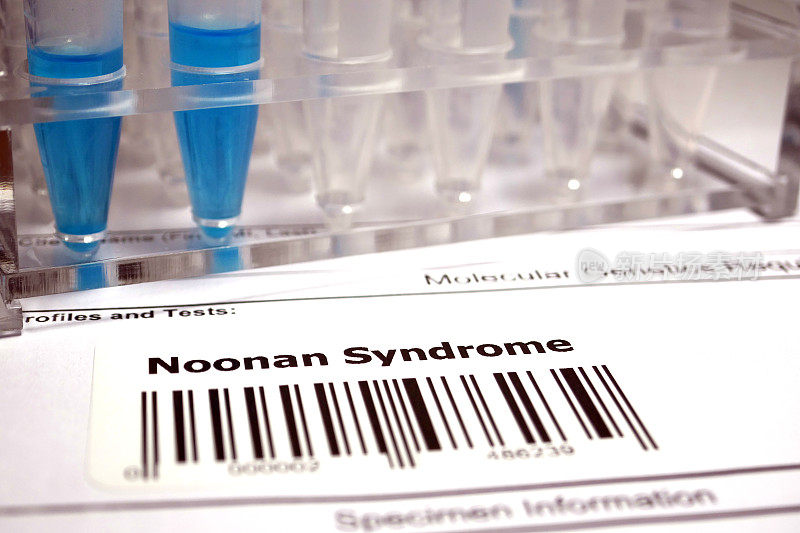 努南综合征-常染色体显性遗传性疾病