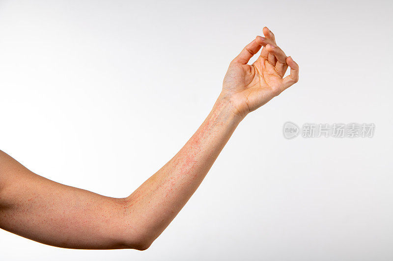 过敏症状手臂上有红疹从过敏原发痒。