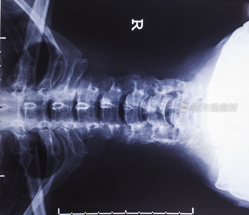 颈部X光片