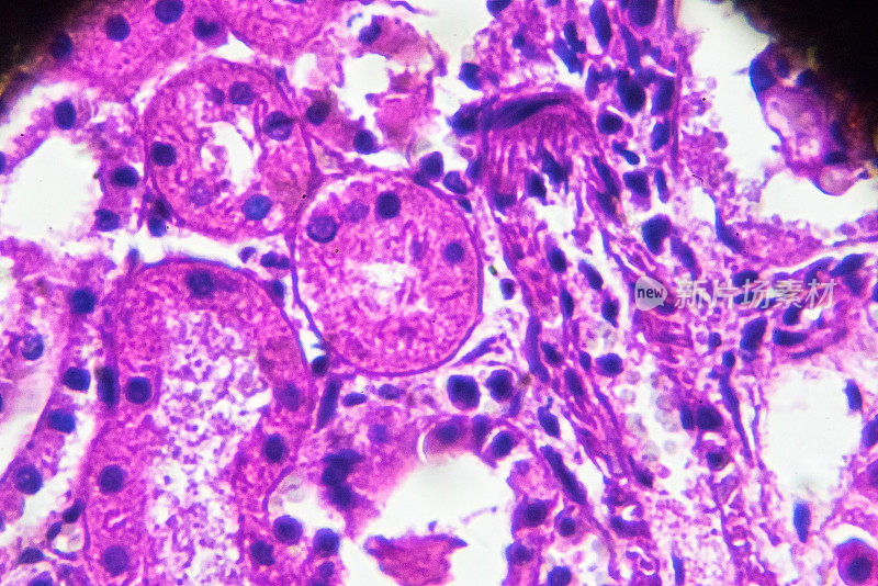 显微镜下急性肾盂肾炎活检标本