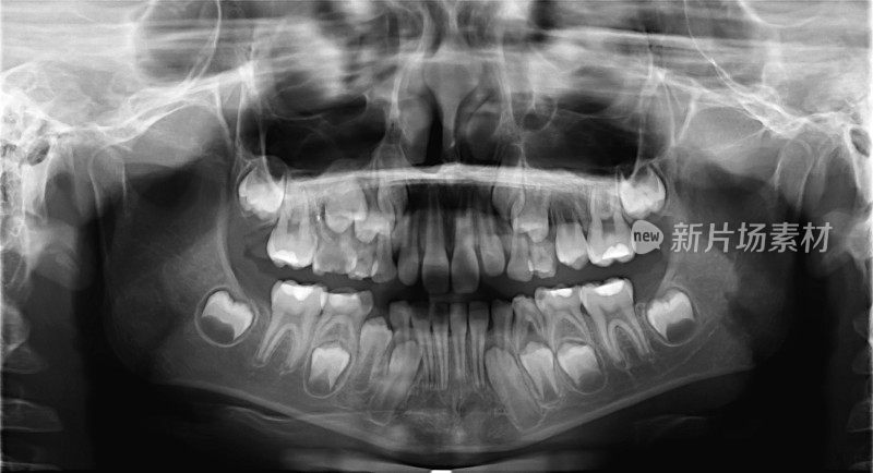 儿童颌牙的x光扫描。全景负面图像的孩子的脸。