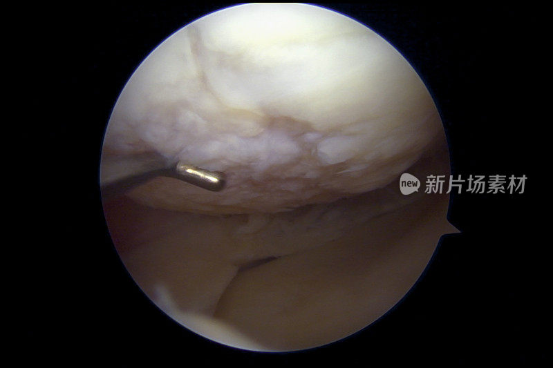 左膝伴有中度骨关节炎和退行性半月板撕裂的关节镜照片
