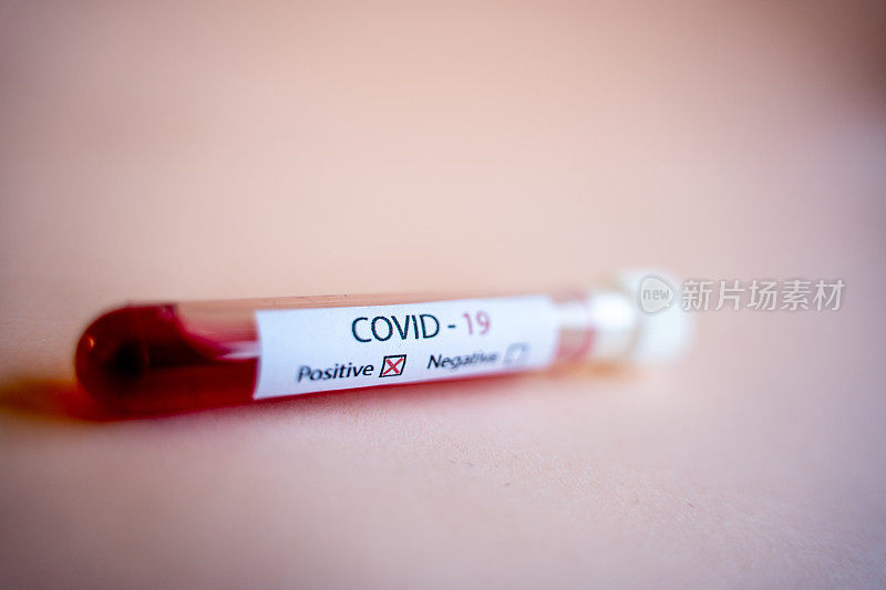 COVID-19病毒血液检测阳性样本的低角特写