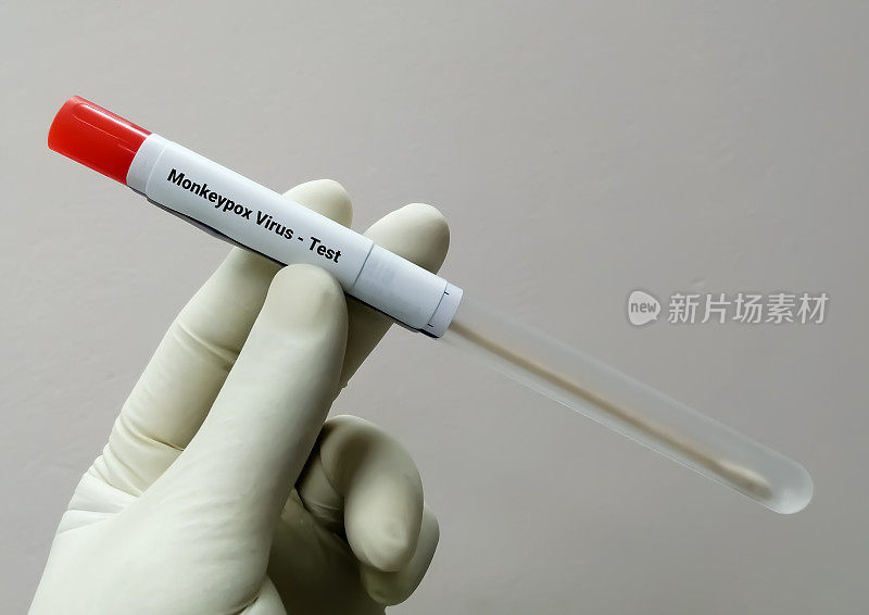 猴痘病毒测试的小泡液样本。它也被称为Moneypox病毒，一种双链DNA病毒和痘病毒科的成员。